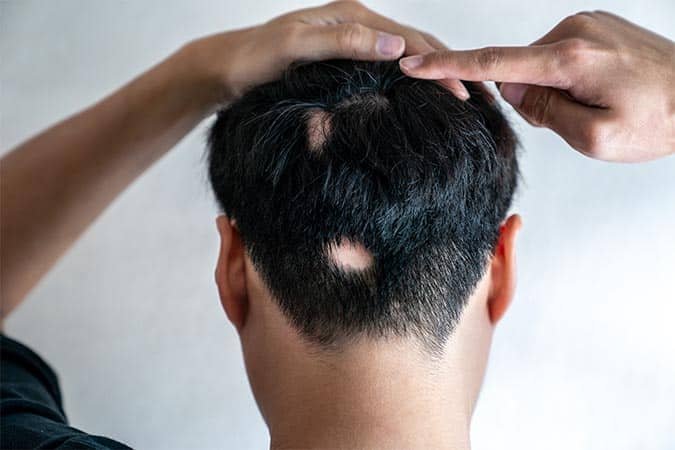 Hair Loss and Alopecia Consultation at Klinik Vistara Healthcare, Klang
